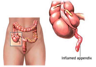Appendisectomy Laparoscopic